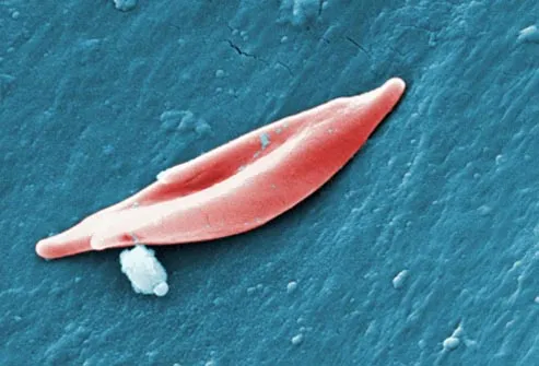 sickle cell red blood cell