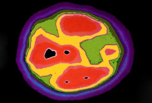 pet scan of autistic brain of four year old