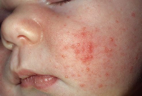Close-up of acne on infant's cheek