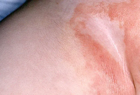 Close-up of infant with diaper rash