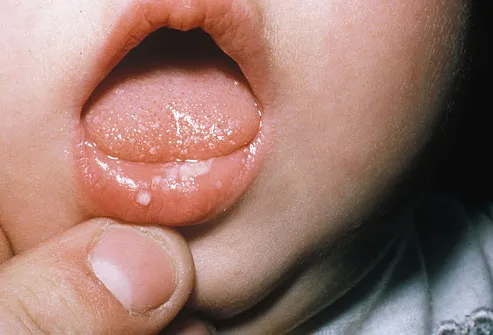 Candidiasis In Men. Close-up of thrush in baby#39;s