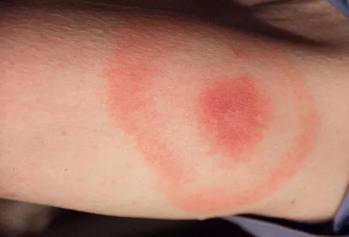 spider bite rash spreading. a circular skin rash.