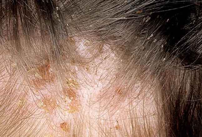 Where can you view photos of head lice?