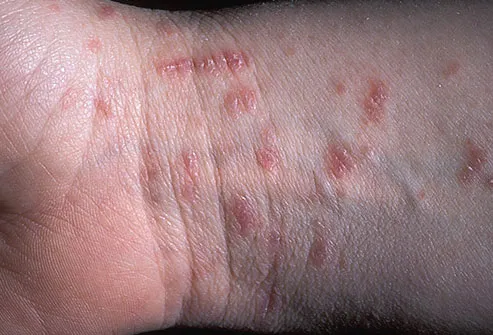are scabies contagious