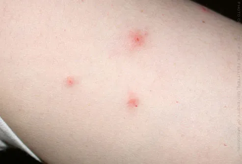 Here's the best way of identifying bug bites on humans on different ...