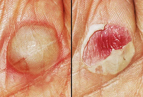 How can you get rid of sores between your toes?