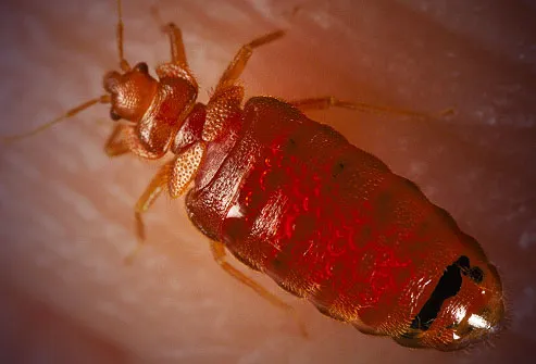 BED BUGS IN HAIR PICTURES