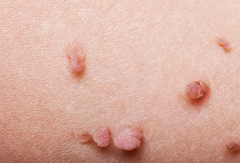 Bumps Under Skin On Vagina 91