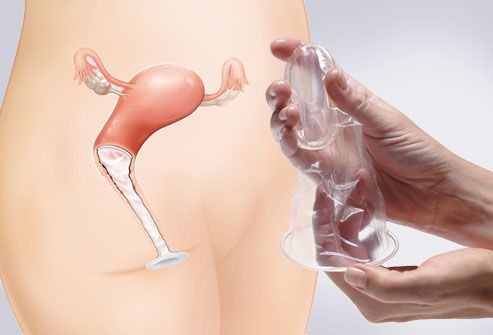 how to use women condom. Female Condom