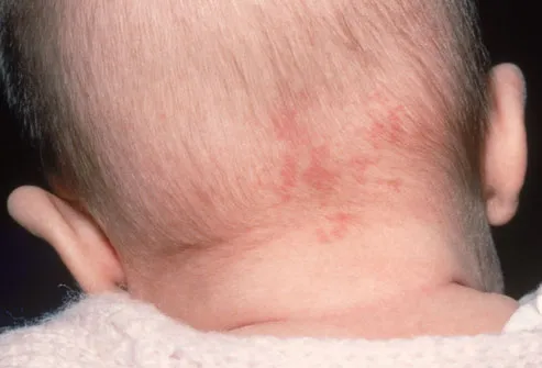 Vascular birthmarks – salmon patches, port wine stains and ...