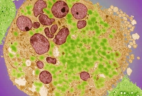 micrograph of bladder cancer