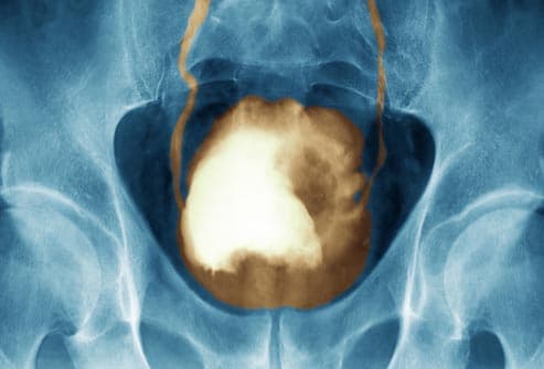 x-ray of cancerous bladder tumor