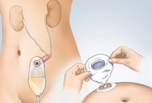 illustration of catheter