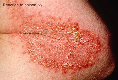 What are some diseases that cause blisters?