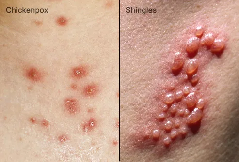 Herpes zoster (shingles) on the hand: MedlinePlus Medical ...