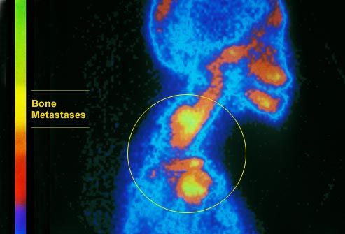 What are the signs and symptoms of bone metastasis?