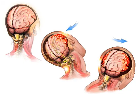 illustration of a concussion