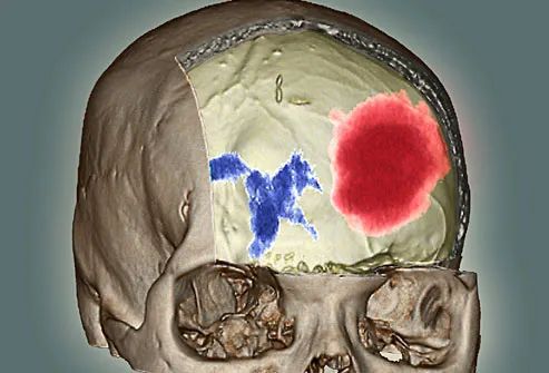 brain hematoma