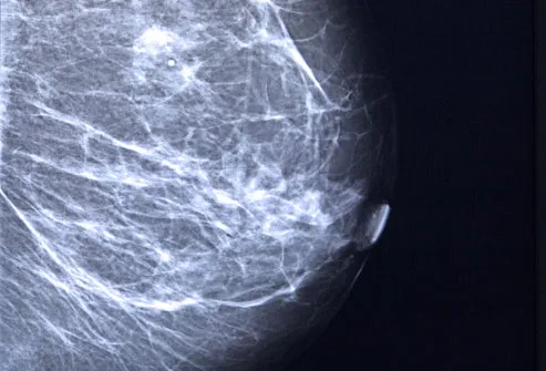 Mammogram Of Breast