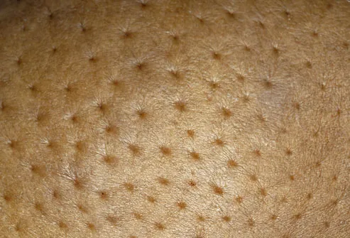 Skin Showing Inflammatory Breast Cancer