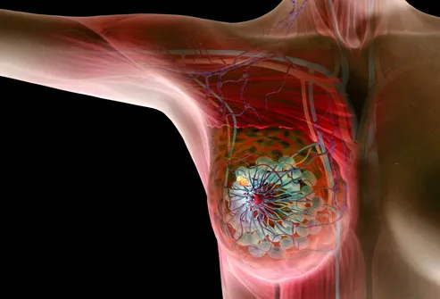 Illustration Of Breast Cancer