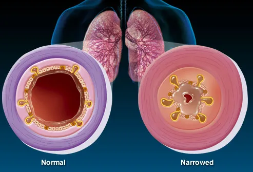 Illustration of normal vs. narrowed bronchioles