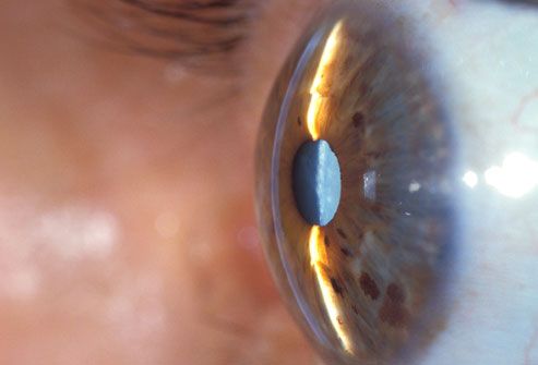 Cataract On Eye Seen From Side