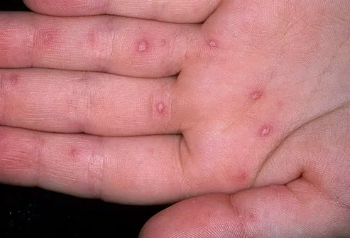 Hand - Foot- Mouth Disease on Hand