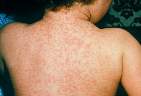 Measles Rash on Back of Boy