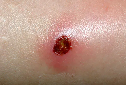 Close-Up of MRSA Infection