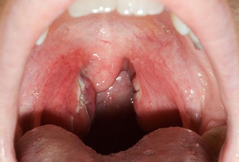Strep Throat Close-Up