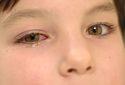 Child With Pink Eye