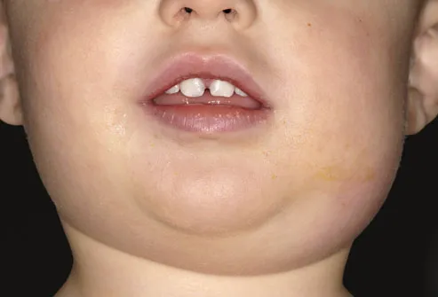 Mumps Symptoms on Childs Faceill