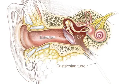 Diagram of an Ear Infection