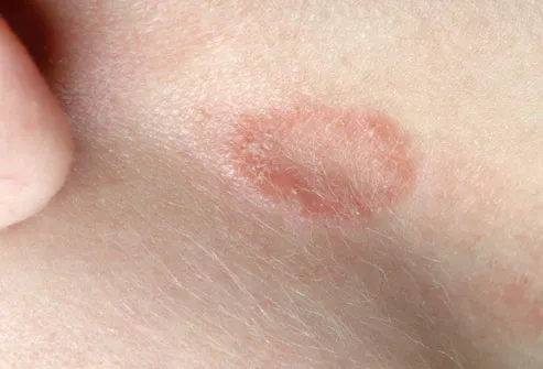 Red spots and Swollen neck lymph nodes - Right Diagnosis