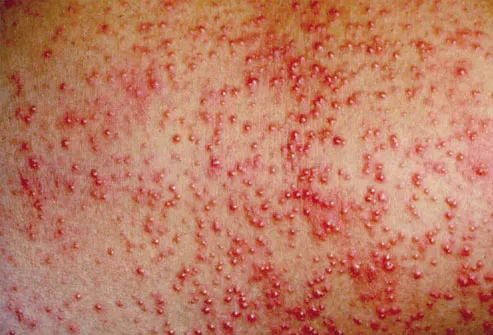 pictures of poison sumac rash. and shoulders, the rash is