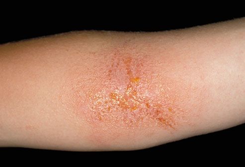 What are some symptoms of skin dermatitis?