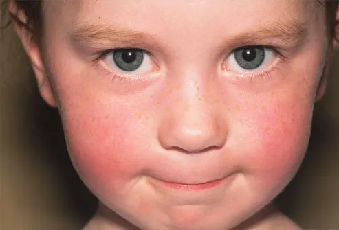 heat rash pictures in children. by a face and body rash.