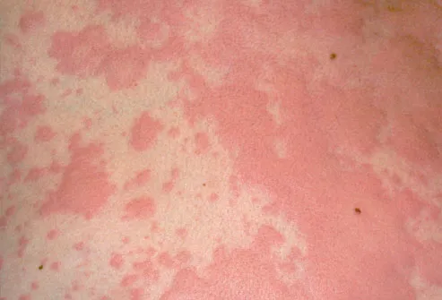 Photo of Hives (Urticaria) Skin Rash