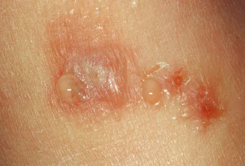 pictures of poison sumac rash. The rash usually starts within