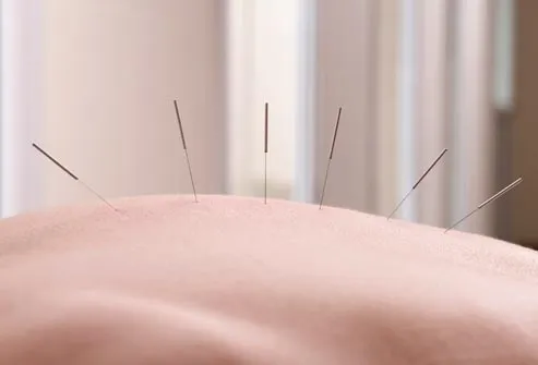 jarum akupunktur di belakang