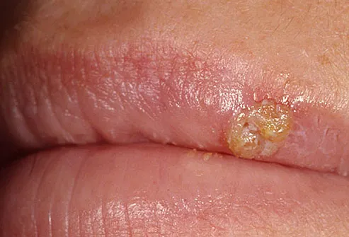 Close-up of oozing cold sore blister