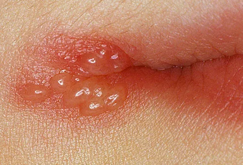 Close-up of herpes blisters, cold sore