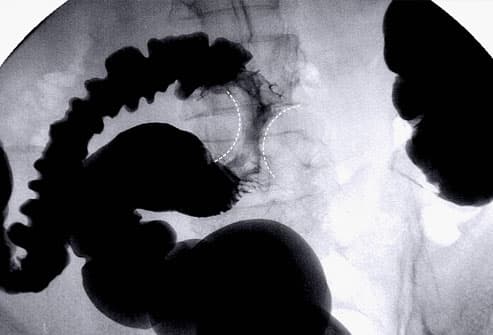 X-ray of colon cancer