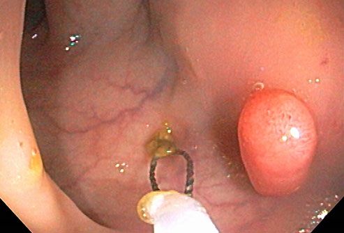 Close-up of colon polyp removal procedure