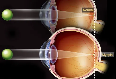 Illustration Of Myopia