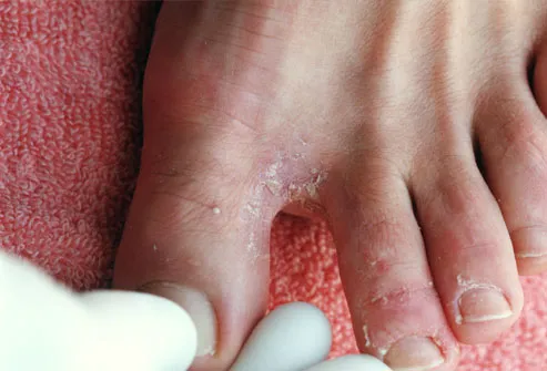 foot diseases pictures