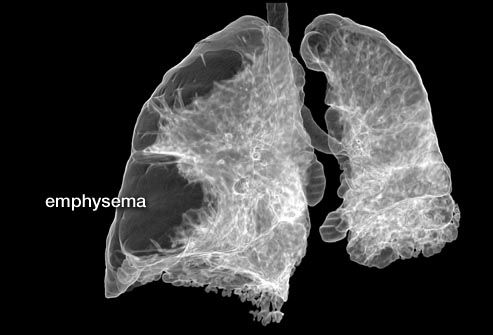 ct scan of lungs with emphysema