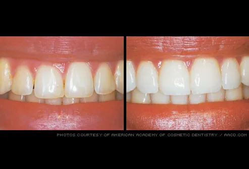 uneven gum line refined by gum reshaping