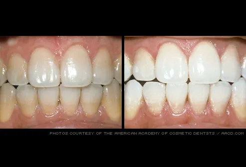 stained teeth professionally whitened